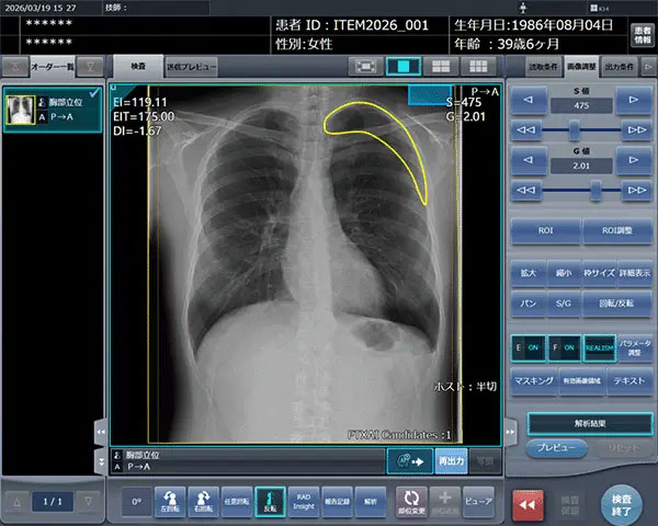 「CXR Finding-i 気胸検出タイプ」により解析された気胸の検出領域を表示
